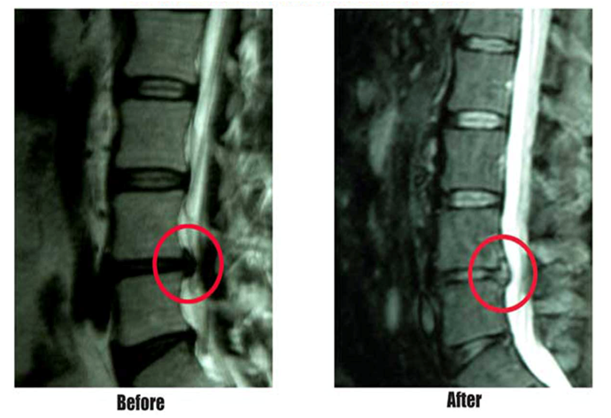 IDD Therapy treatment before & after patient MRI with herniated disc.
